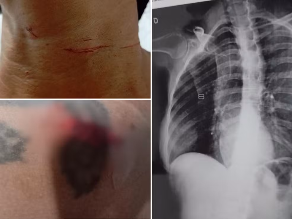 Motociclista se joga do veículo após ser atingida por linha com cerol e sofre fraturas em Santos